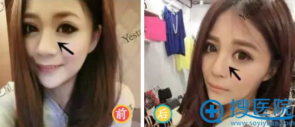 北京艺星隆鼻手术效果怎么样 北京艺星隆鼻手术效果怎么样