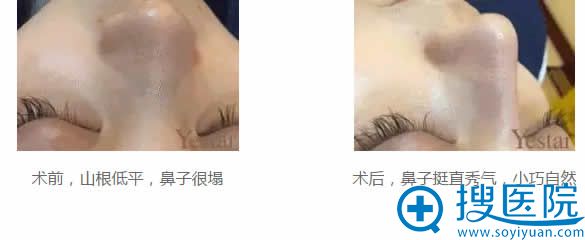 北京艺星注射玻尿酸隆鼻案例 北京艺星注射玻尿酸隆鼻案例
