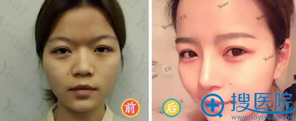 北京Yestar隆鼻手术前后对比照 北京Yestar隆鼻手术前后对比照