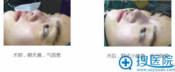 北京艺星鼻综合整形效果怎么样 北京艺星鼻综合整形效果怎么样