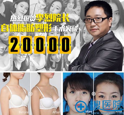 成都恒博李烈院长自体脂肪填充案例 成都恒博李烈院长自体脂肪填充案例