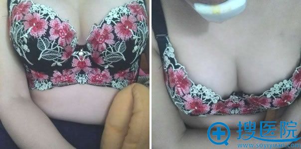 自体脂肪注射隆胸10天的效果 自体脂肪注射隆胸10天的效果