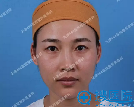 双眼皮割窄后闺蜜陪我找天津464刘旺做了双眼皮失败修复手术