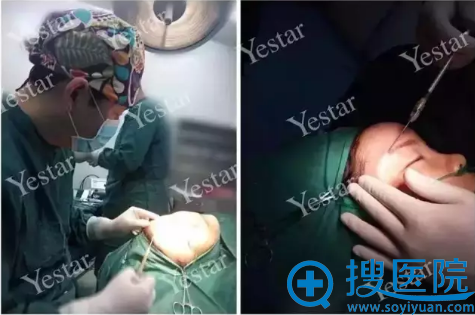 合肥艺星脂肪丰额头+太阳穴+下巴手术中 合肥艺星脂肪丰额头+太阳穴+下巴手术中