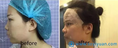 合肥艺星自体脂肪术后即刻对比照 合肥艺星自体脂肪术后即刻对比照