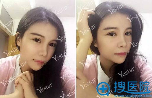 合肥艺星脂肪丰额头太阳穴下巴术后10天恢复情况 合肥艺星脂肪丰额头太阳穴下巴术后10天恢复情况