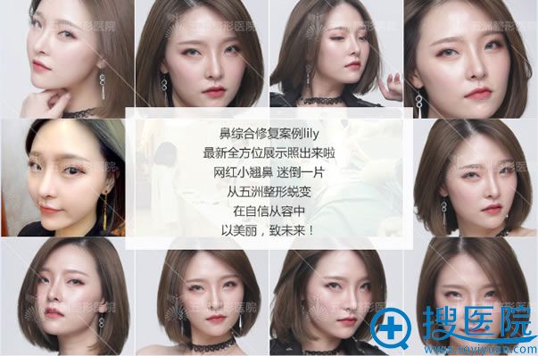 武汉五洲鼻综合修复手术效果 武汉五洲鼻综合修复手术效果