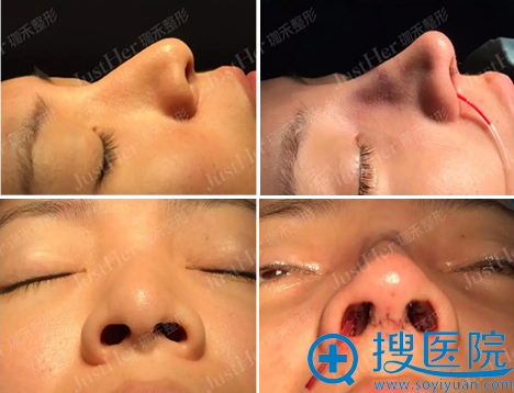 <!--<i data=20240710 data-id=10239></i>-->顾伟明膨体+肋软骨隆鼻术后即刻对比图 <!--<i data=20240710 data-id=10239></i>-->顾伟明膨体+肋软骨隆鼻术后即刻对比图