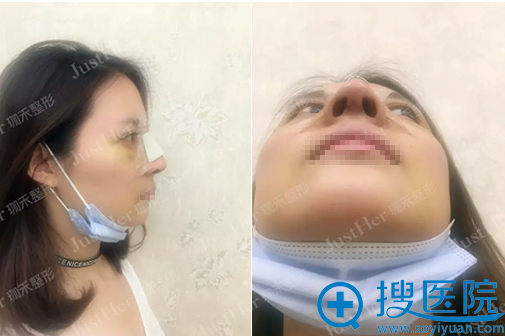 <!--<i data=20240710 data-id=10239></i>-->顾伟明膨体+肋软骨隆鼻术后三天恢复效果 <!--<i data=20240710 data-id=10239></i>-->顾伟明膨体+肋软骨隆鼻术后三天恢复效果