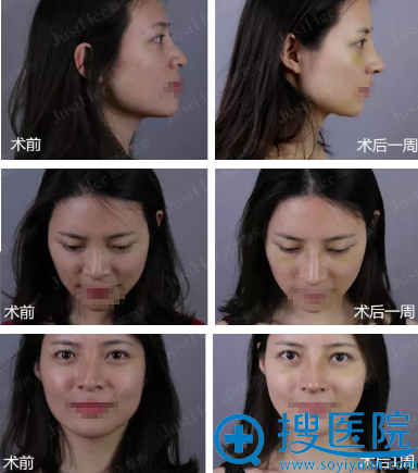 <!--<i data=20240710 data-id=10239></i>-->顾伟明膨体+肋软骨隆鼻恢复一周对比图片 <!--<i data=20240710 data-id=10239></i>-->顾伟明膨体+肋软骨隆鼻恢复一周对比图片