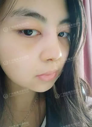 广州晨曦整形陈柯鼻综合案例:膨体隆鼻+鼻翼缩小+鼻中隔延长