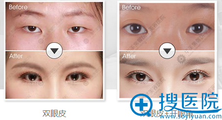 <!--<i data=20240710 data-id=13402></i>-->陈杨双眼皮+开眼角案例 <!--<i data=20240710 data-id=13402></i>-->陈杨双眼皮+开眼角案例