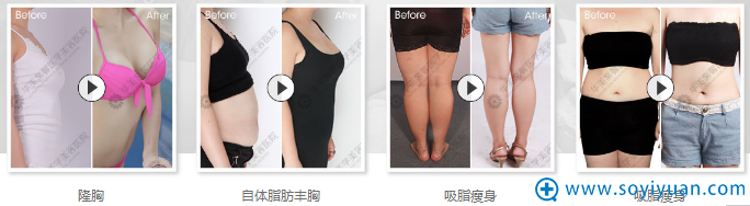 四川华美紫隆胸+吸脂案例 四川华美紫隆胸+吸脂案例