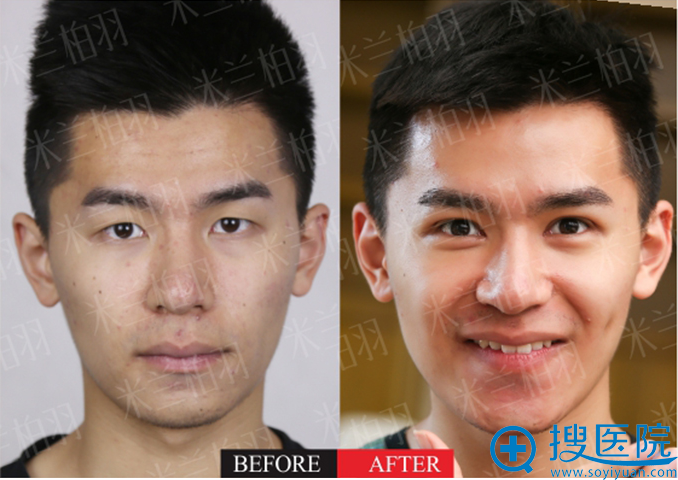 <!--<i data=20240710 data-id=13413></i>-->柏羽男生双眼皮案例 <!--<i data=20240710 data-id=13413></i>-->柏羽男生双眼皮案例