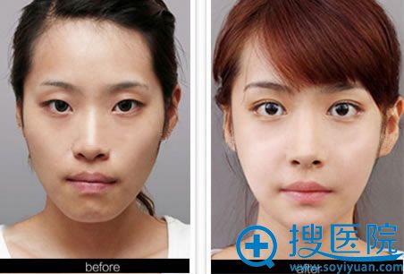 <!--<i data=20240710 data-id=13582></i>-->美容医院双眼皮案例图 <!--<i data=20240710 data-id=13582></i>-->美容医院双眼皮案例图