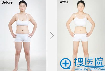 <!--<i data=20240710 data-id=13582></i>-->整形腰腹吸脂前后对比图 <!--<i data=20240710 data-id=13582></i>-->整形腰腹吸脂前后对比图