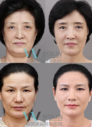 真相!韩国原辰脂肪填充哪位院长做的好 医院地址在哪里