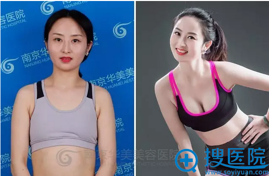 南京正规隆胸医院哪家好 南京华美假体隆胸让产后妈妈从A升到C