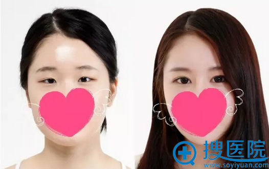 常州美贝尔邹志英双眼皮案例对比照片 常州美贝尔邹志英双眼皮案例对比照片