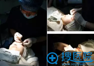 常州美贝尔邹志英双眼皮过程 常州美贝尔邹志英双眼皮过程