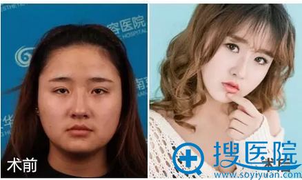 南京华美曹海峰鼻综合隆鼻案例效果怎么样 大家都说我美呆了