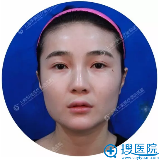 国内磨骨哪个医生好?上海华美李志海做的下颌角真实案例告诉你