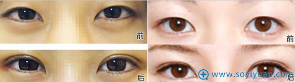 <!--<i data=20240710 data-id=13535></i>-->整形医院双眼皮对比效果 <!--<i data=20240710 data-id=13535></i>-->整形医院双眼皮对比效果