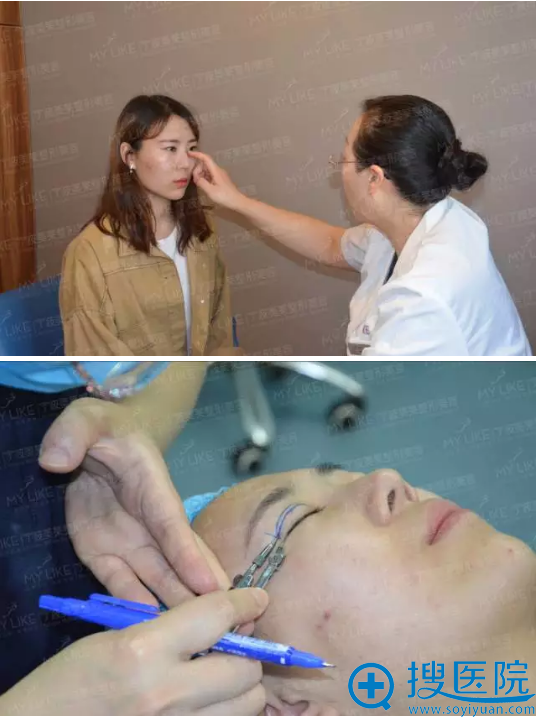 对比后选择宁波美莱郑景芳做了双眼皮和隆鼻,好不好看你说了算