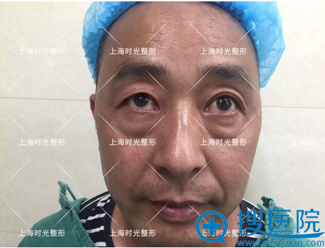 李先生术前眼袋很严重 李先生术前眼袋很严重