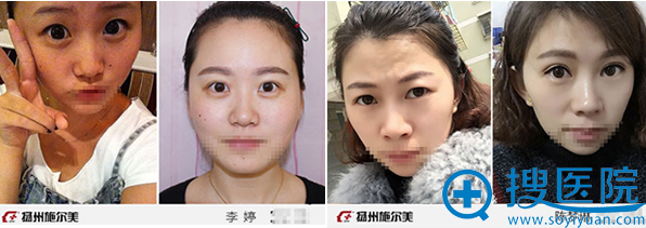 <!--<i data=20240710 data-id=12266></i>-->厉建华双眼皮案例对比图 <!--<i data=20240710 data-id=12266></i>-->厉建华双眼皮案例对比图