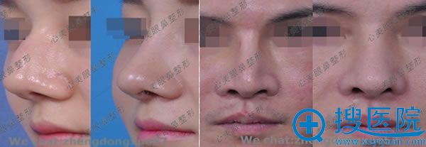 <!--<i data=20240710 data-id=16649></i>-->教授鼻修复案例图 <!--<i data=20240710 data-id=16649></i>-->教授鼻修复案例图