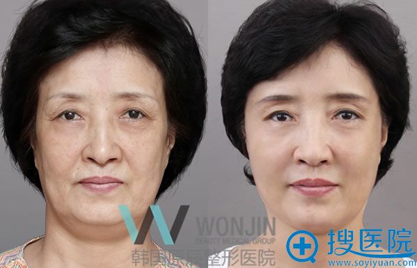 韩国原辰整形外科朴院长面部脂肪填充案例 韩国原辰整形外科朴院长面部脂肪填充案例