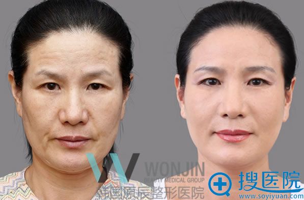 原辰李尚俸院长全脸脂肪填充对比图 原辰李尚俸院长全脸脂肪填充对比图
