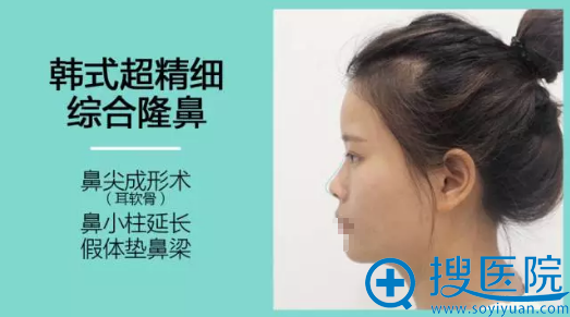 杭州瑞丽耳软骨鼻综合术前侧面照 杭州瑞丽耳软骨鼻综合术前侧面照