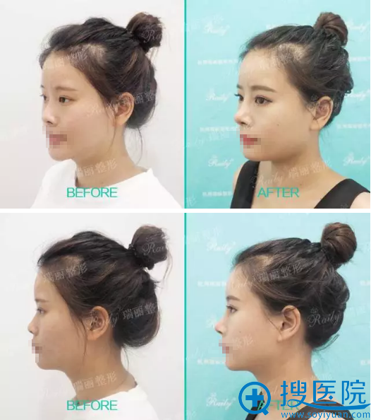 杭州瑞丽耳软骨鼻综合术后对比照片 杭州瑞丽耳软骨鼻综合术后对比照片