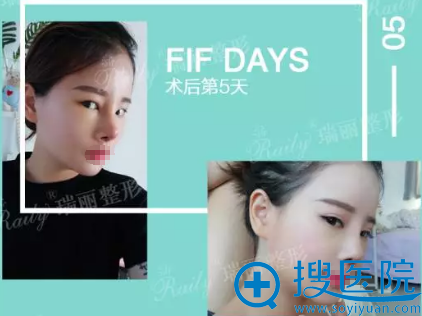 杭州瑞丽耳软骨鼻综合术后5天照片 杭州瑞丽耳软骨鼻综合术后5天照片