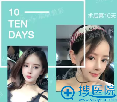 杭州瑞丽耳软骨鼻综合拆线后照片 杭州瑞丽耳软骨鼻综合拆线后照片