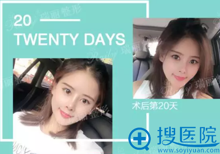 杭州瑞丽耳软骨鼻综合术后20天恢复照片 杭州瑞丽耳软骨鼻综合术后20天恢复照片