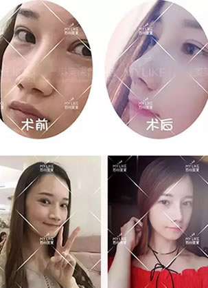 鼻综合隆鼻日记:膨体垫鼻梁+耳软骨垫鼻尖+鼻翼缩小恢复过程
