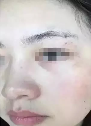 皮秒祛斑怎么样 蚌埠美莱蜂巢皮秒激光祛斑真实效果展示