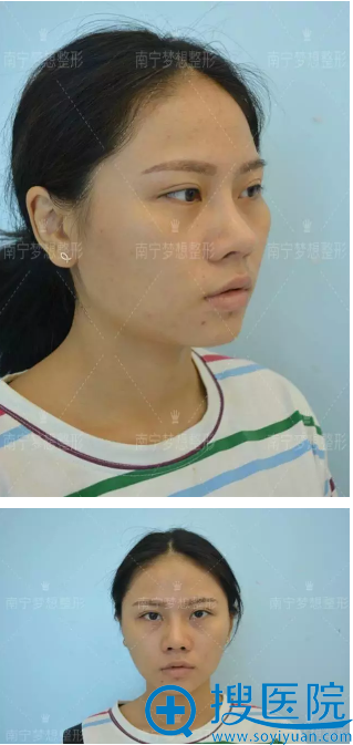 自体脂肪填充术前照片 自体脂肪填充术前照片