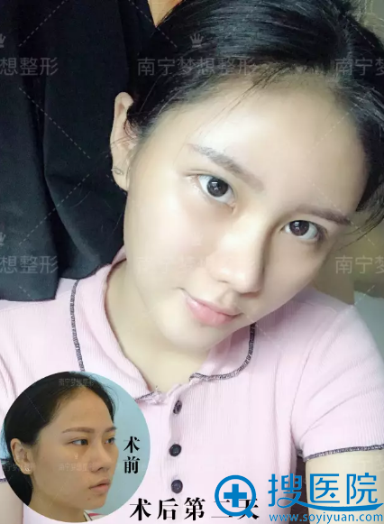 南宁梦想自体脂肪面部填充术后第二天效果 南宁梦想自体脂肪面部填充术后第二天效果