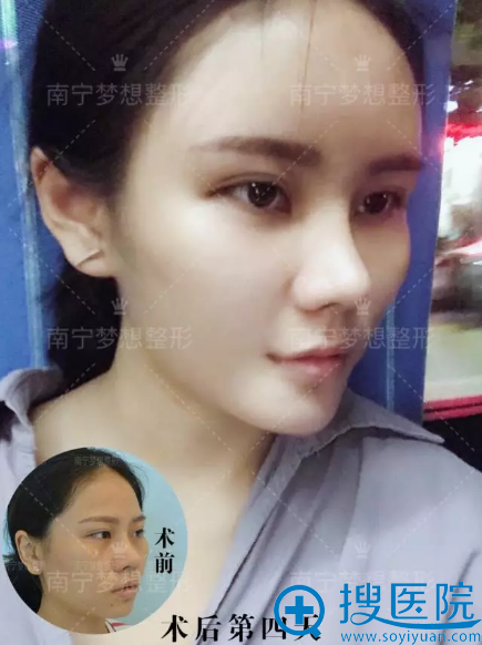 南宁梦想自体脂肪填充4天后的效果 南宁梦想自体脂肪填充4天后的效果