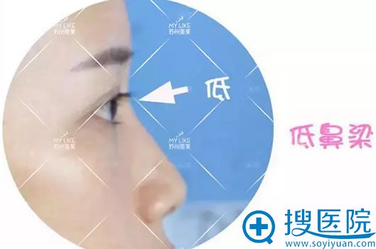 术前鼻子的侧面照片 术前鼻子的侧面照片