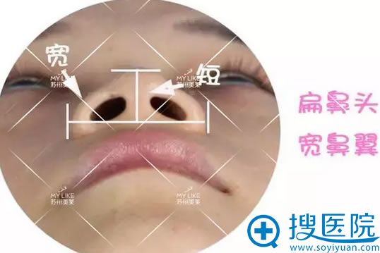 隆鼻前鼻子扁平和鼻翼宽大 隆鼻前鼻子扁平和鼻翼宽大