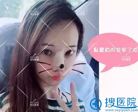 鼻综合隆鼻整形术后第三天美照 鼻综合隆鼻整形术后第三天美照