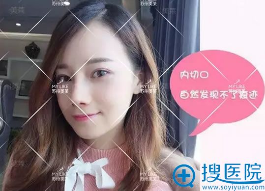 鼻翼缩小术后15天美照 鼻翼缩小术后15天美照