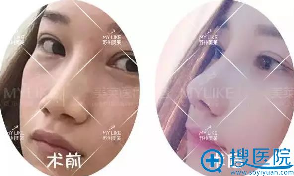 <!--<i data=20240710 data-id=13583></i>-->鼻综合整形前后对比照 <!--<i data=20240710 data-id=13583></i>-->鼻综合整形前后对比照