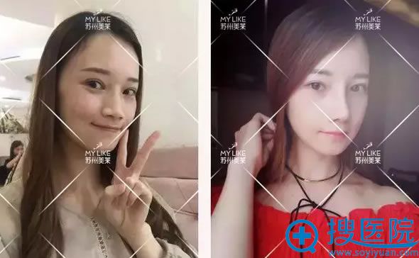 膨体垫鼻梁+耳软骨塑鼻尖+鼻翼缩小前后对比图 膨体垫鼻梁+耳软骨塑鼻尖+鼻翼缩小前后对比图