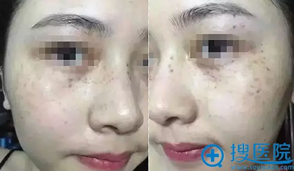 皮秒祛斑术后第2天照片 皮秒祛斑术后第2天照片